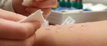 Allergy Testing in Children 